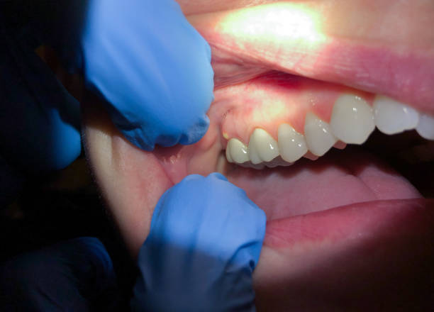 Best Emergency Wisdom Teeth Removal in Danvle, IL