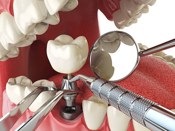 Best Emergency Denture Repair in Danvle, IL